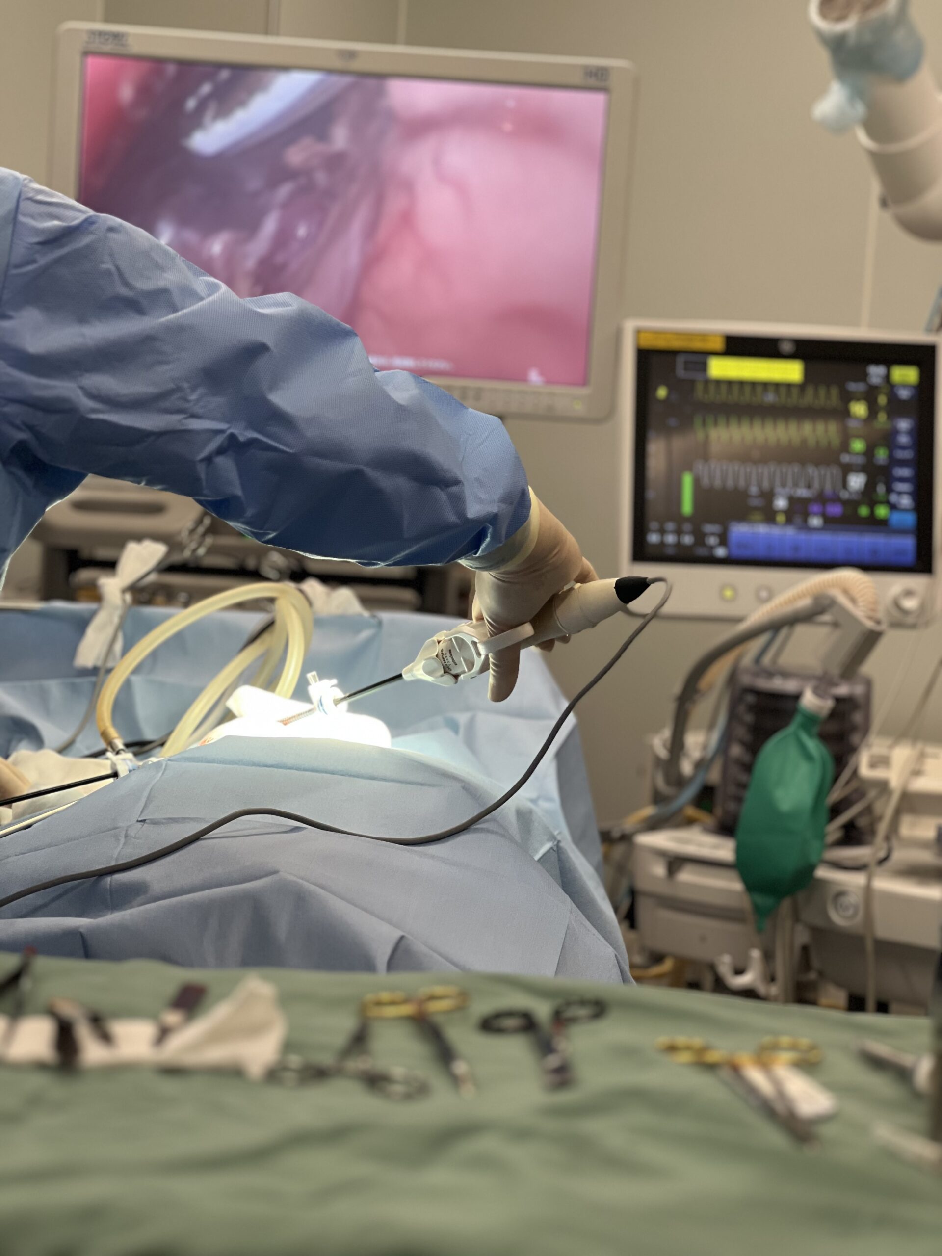 腹腔鏡ってどんな手術？