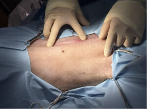 手術でできる予防 腹腔鏡下胃腹壁固定術をご紹介します！