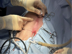 手術でできる予防 腹腔鏡下胃腹壁固定術をご紹介します！