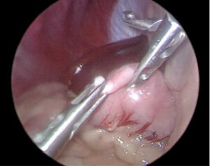 手術でできる予防 腹腔鏡下胃腹壁固定術をご紹介します！