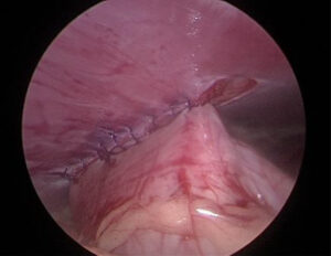 手術でできる予防 腹腔鏡下胃腹壁固定術をご紹介します！
