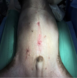 手術でできる予防 腹腔鏡下胃腹壁固定術をご紹介します！