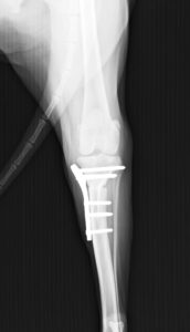 左側前十字靭帯断裂