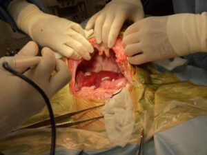 肝臓内側右葉の腫瘤性病変