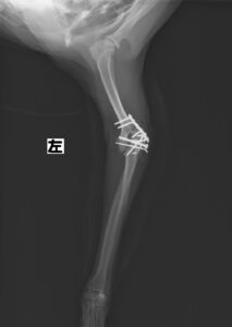 上腕骨骨折（遠位端）