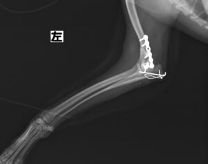 上腕骨骨折（遠位端）