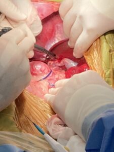 肝臓内側右葉の腫瘤性病変