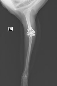 上腕骨骨折（遠位端）