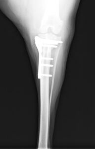 左側前十字靭帯断裂