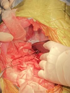 肝臓内側右葉の腫瘤性病変