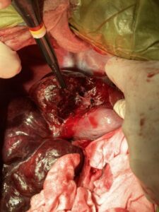 肝臓内側右葉の腫瘤性病変