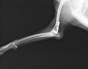 上腕骨骨折（遠位端）