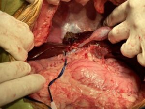 肝臓内側右葉の腫瘤性病変