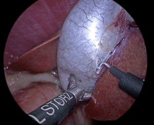 【腹腔鏡による胆嚢摘出】胆嚢粘液嚢腫