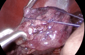 【腹腔鏡による胆嚢摘出】胆嚢粘液嚢腫