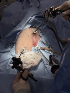 【腹腔鏡による】胃固定術