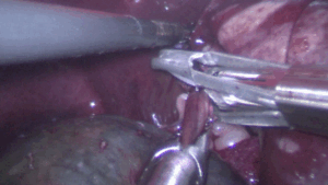 【腹腔鏡による胆嚢摘出】胆嚢粘液嚢腫