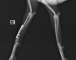 左側橈尺骨骨折
